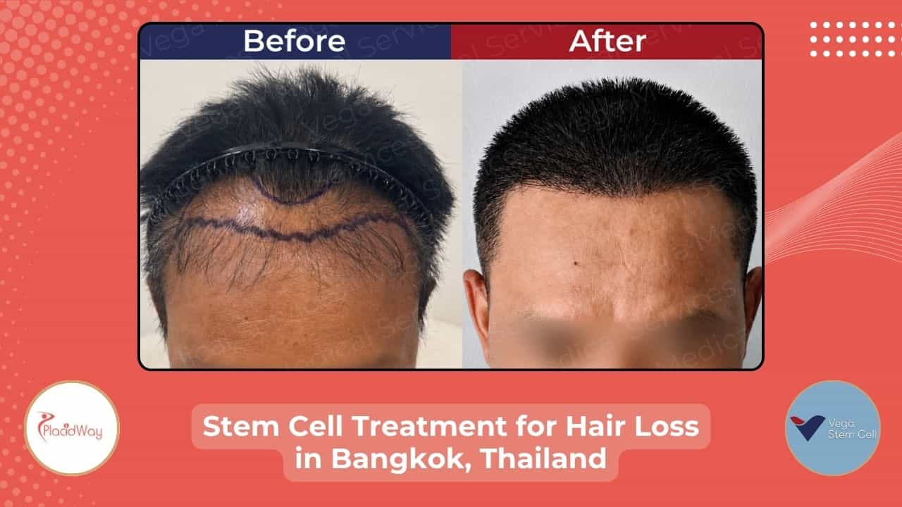 Stem Cell Treatment for Hair in Bangkok, Thailand Before After