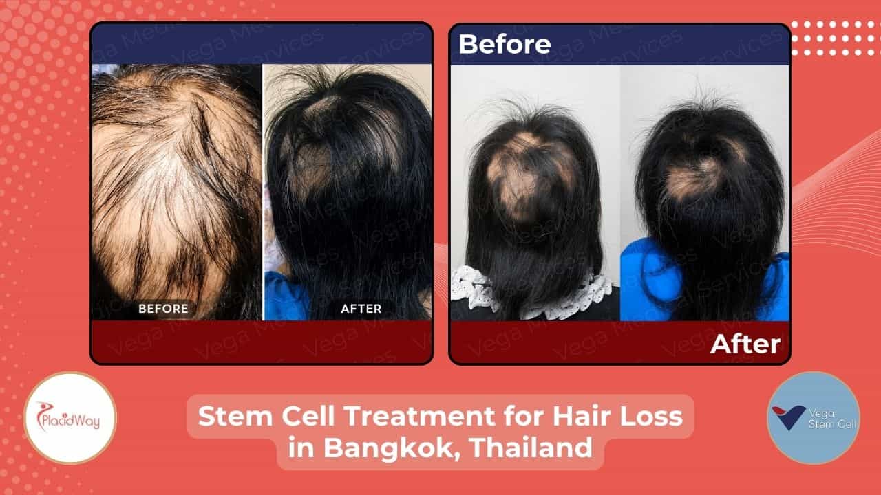 Stem Cell Treatment for Hair in Bangkok, Thailand Review