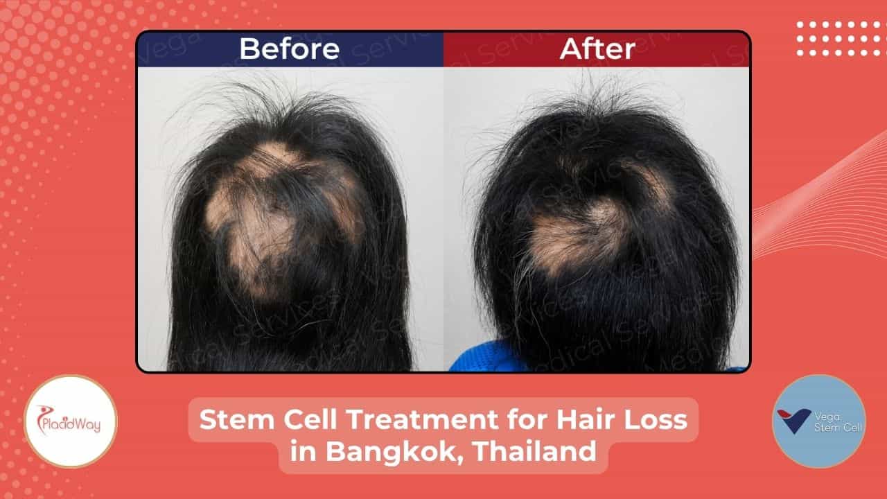 Stem Cell Treatment for Hair in Bangkok, Thailand Story
