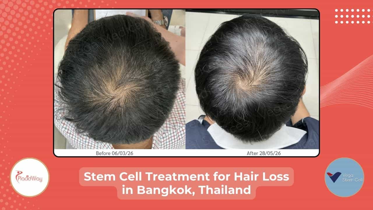 Stem Cell Treatment for Hair in Thailand Before After