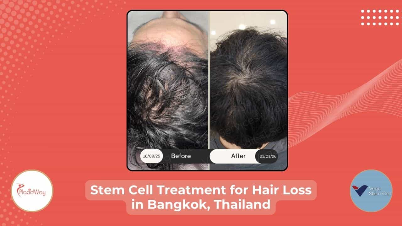Before After Image of Stem Cell Treatment for Hair in Thailand