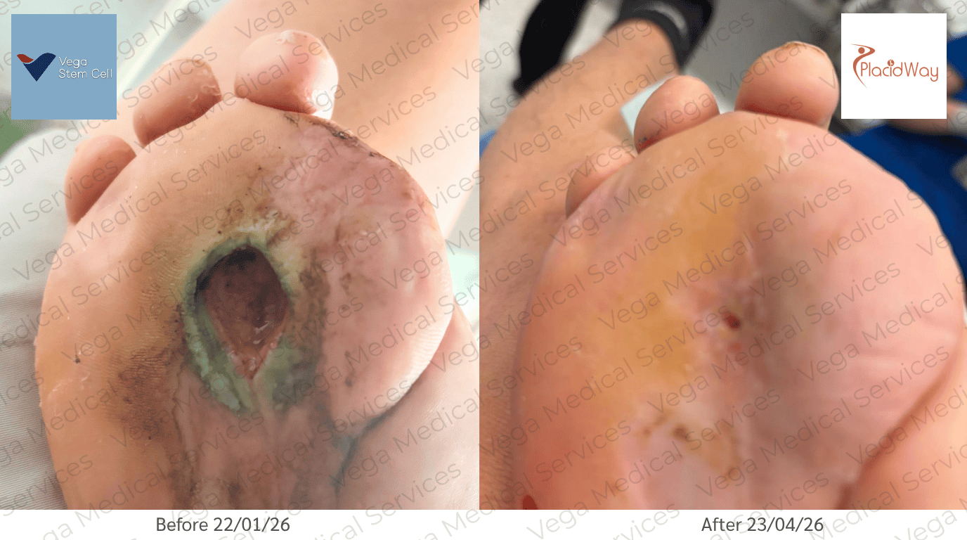 Stem Cell Therapy for Diabetes in Thailand Before and After Image