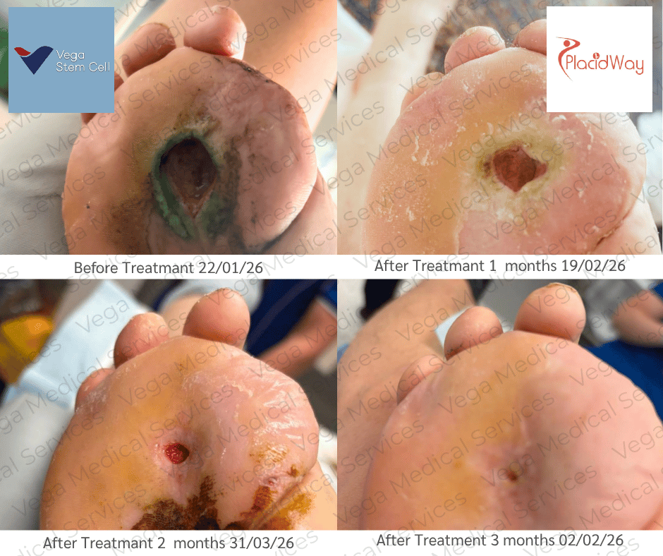 Stem Cell Therapy for Diabetes in Thailand Before After