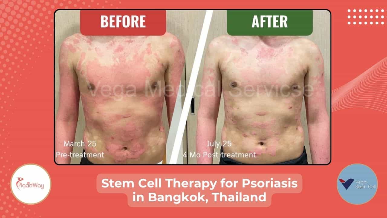 Stem Cell Therapy for Psoriasis in Bangkok Thailand | Vega Clinic Before After