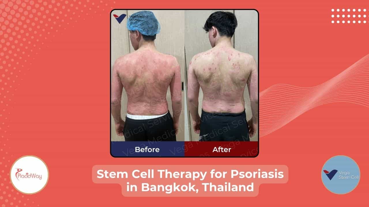 Stem Cell Therapy for Psoriasis in Bangkok Thailand Before After Image