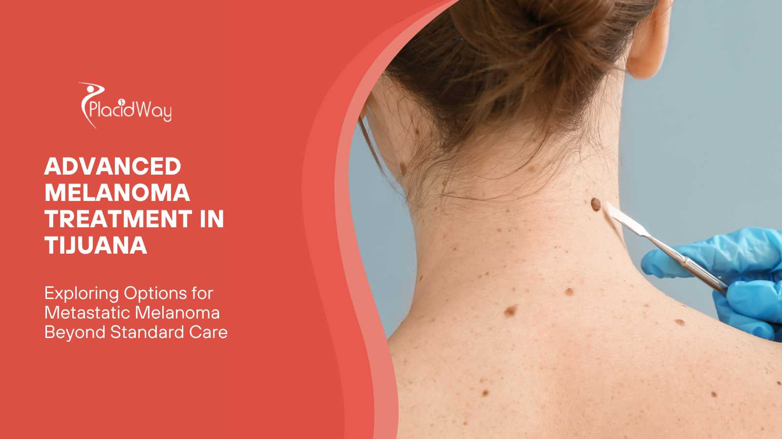 Advanced Melanoma Treatment in Tijuana - Targeting Metastasis When Standard Care Fails