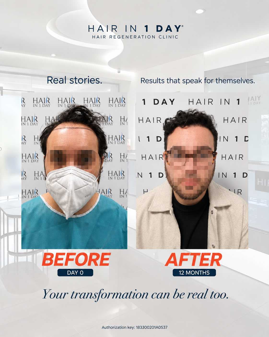 Before and After Hair Restoration in Guadalajara Mexico