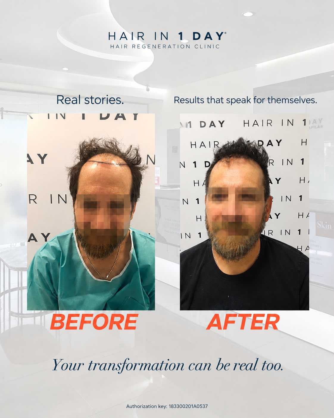 Before and After Hair Restoration in Guadalajara Mexico