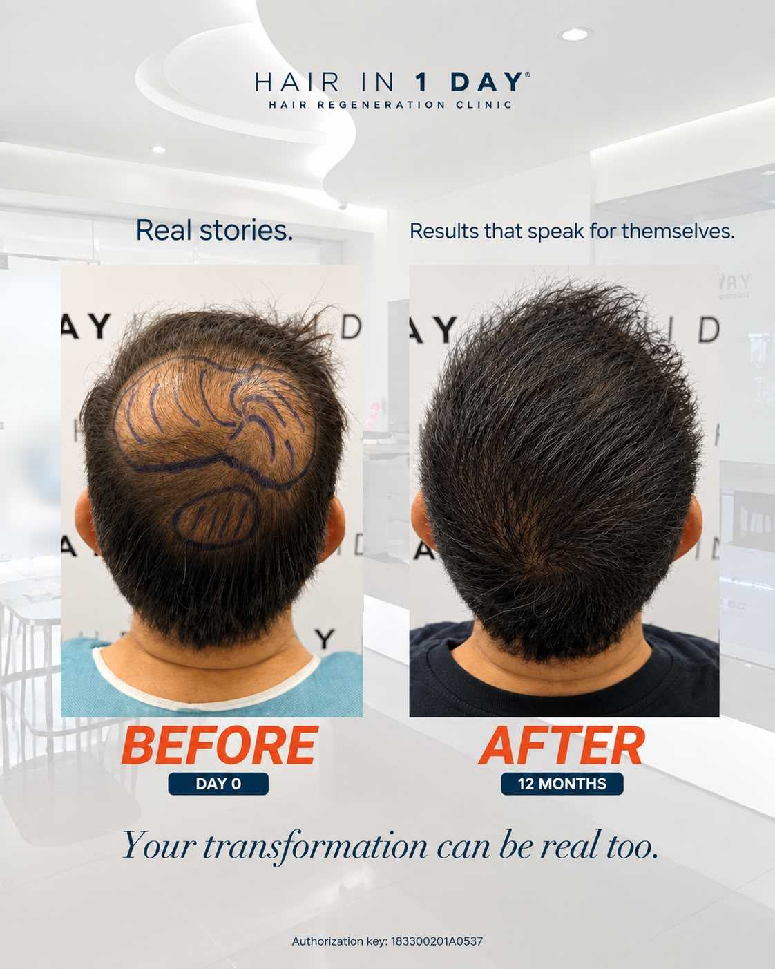 Before and After Hair Restoration in Guadalajara Mexico