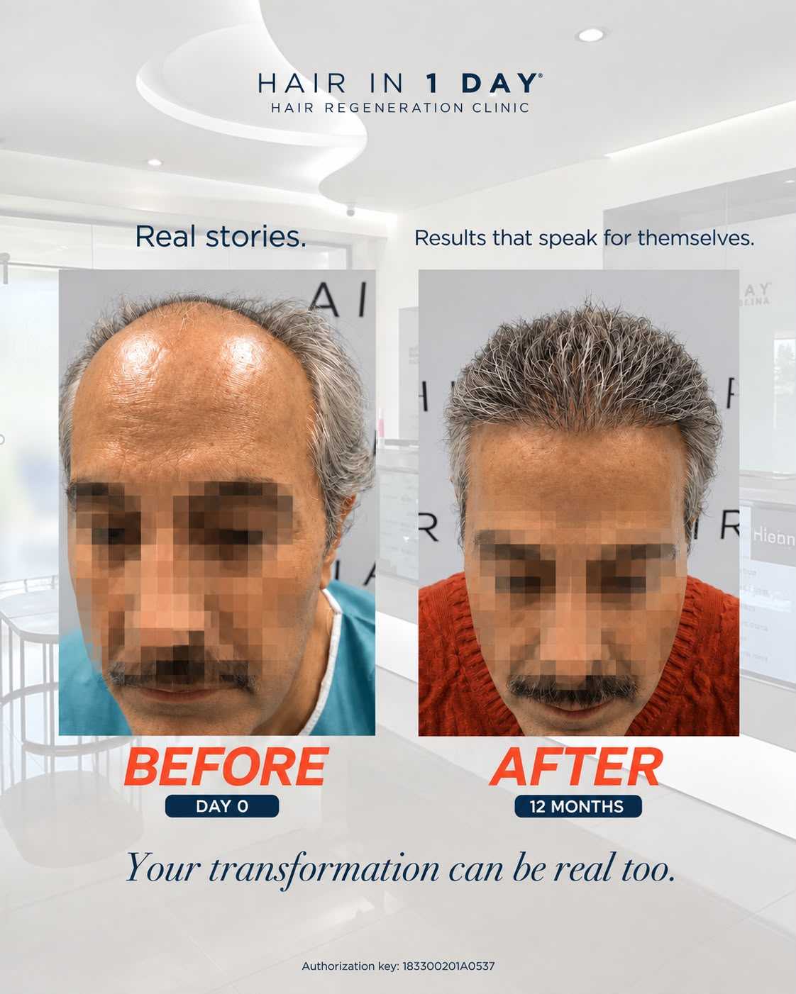 Before and After Hair Restoration in Guadalajara Mexico