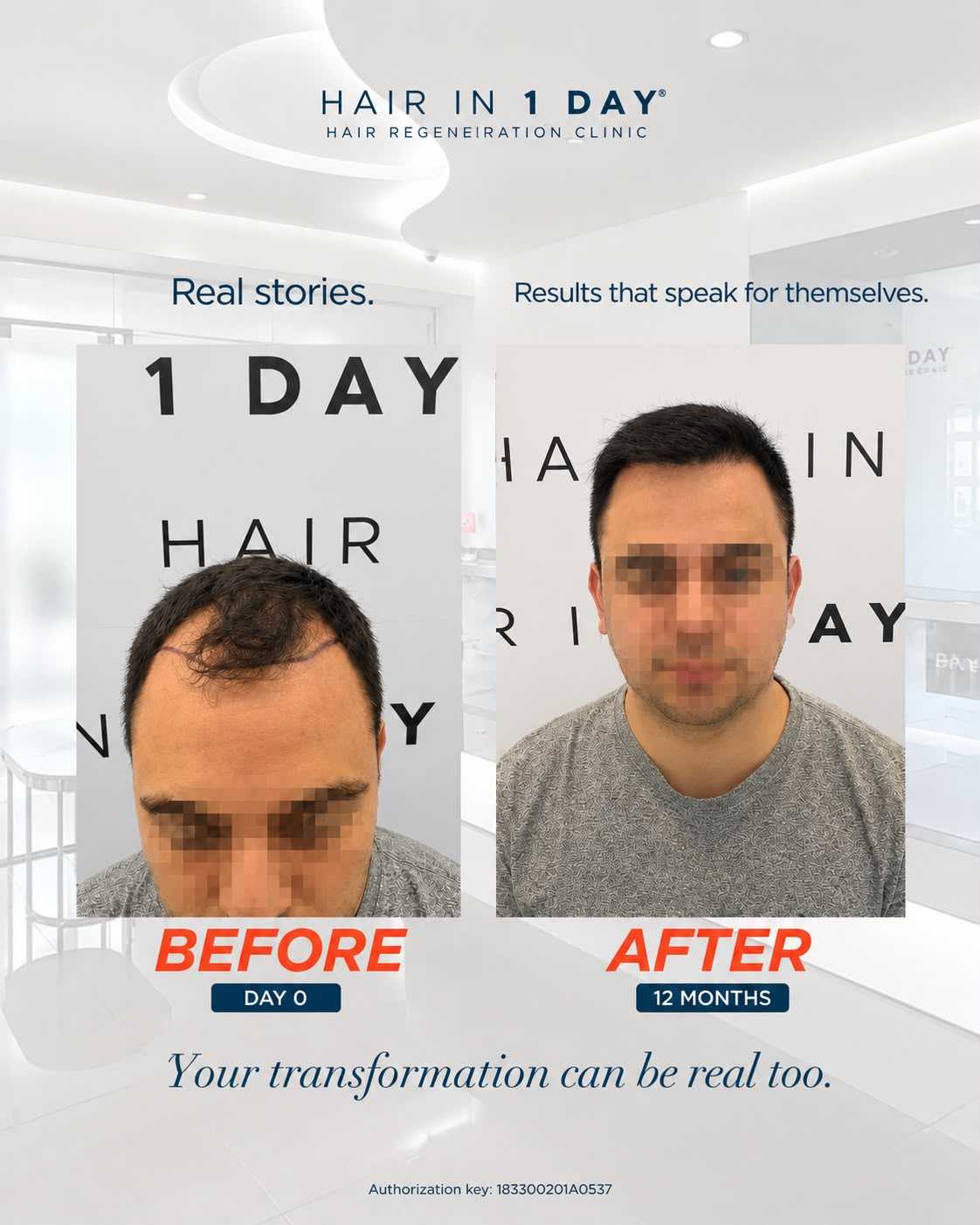 Before and After Hair Restoration in Guadalajara Mexico