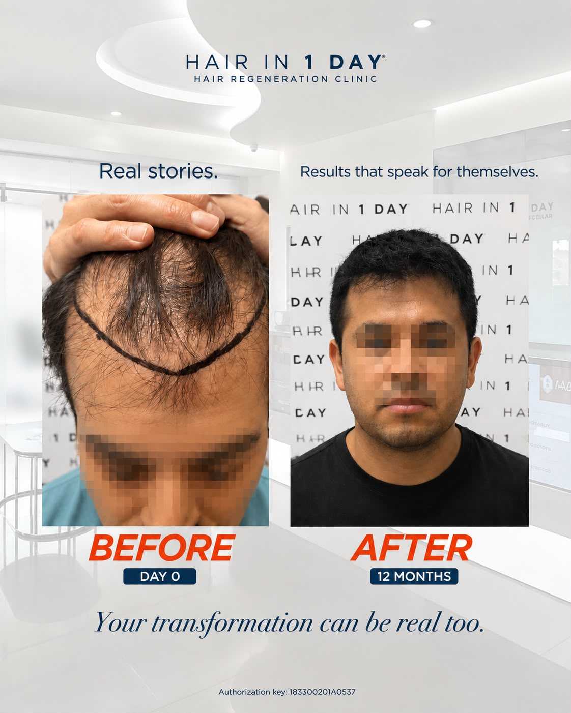 Before and After Hair Transplant in Guadalajara Mexico