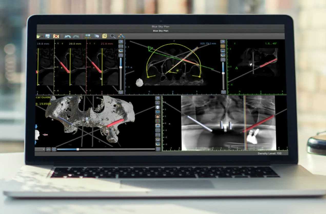 3D virtual planning of a zygomatic implant case on the computer