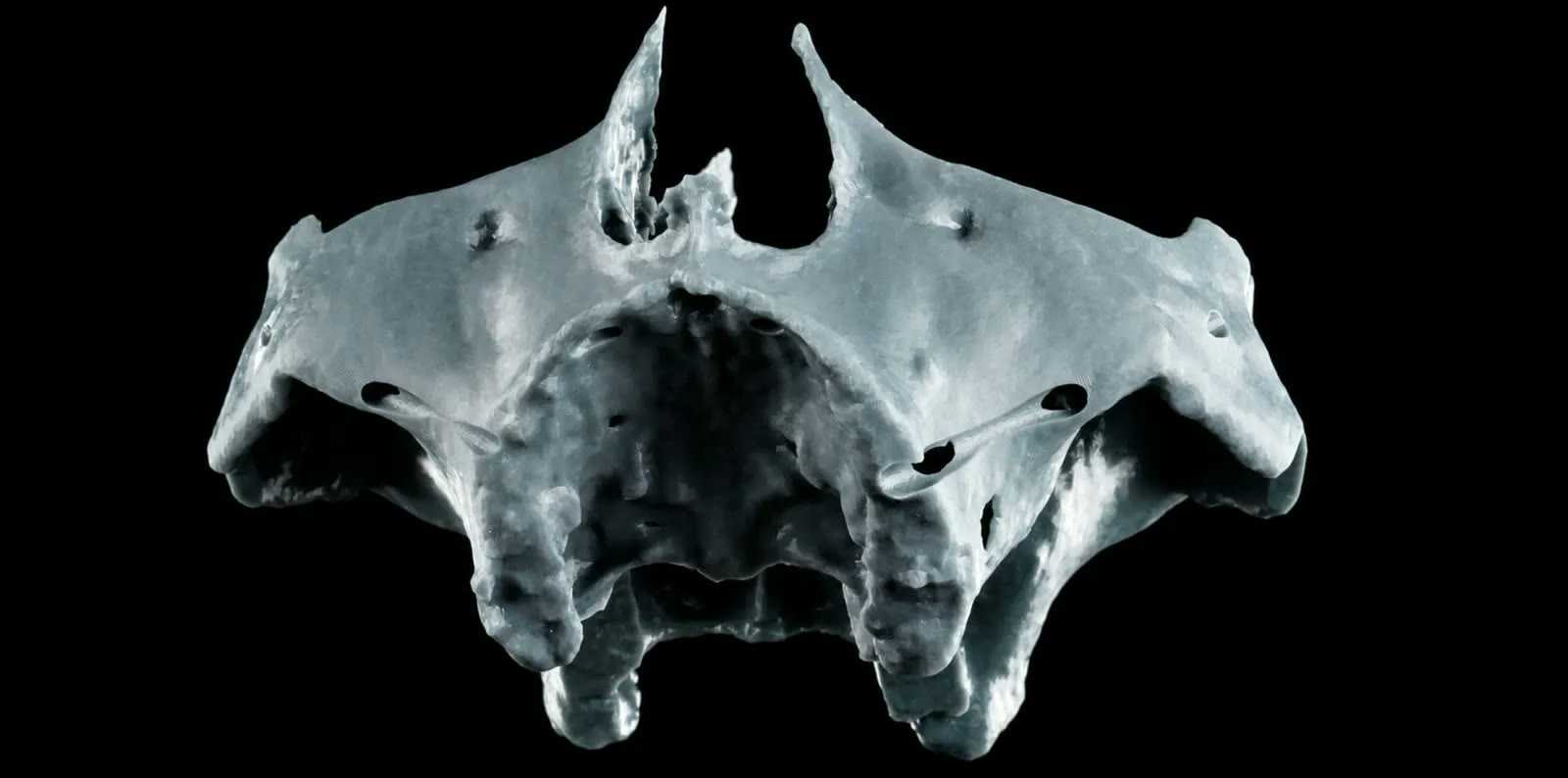 3D-printed replica of the patient's upper jaw used to rehearse the surgery