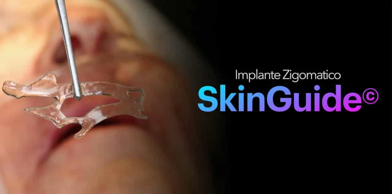 The SkinGuide custom surgical guide in biocompatible resin positioned on the patient