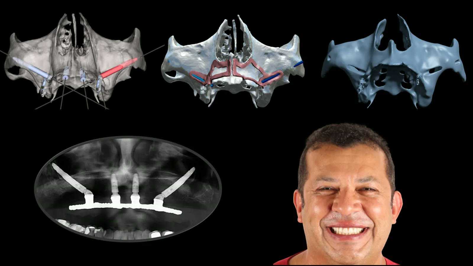 A complete case: virtual models, the final X-ray with the implants and the patient's smile