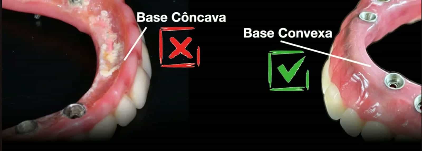 Difference between a concave denture-like base and the convex, cleanable base of a fixed prosthesis