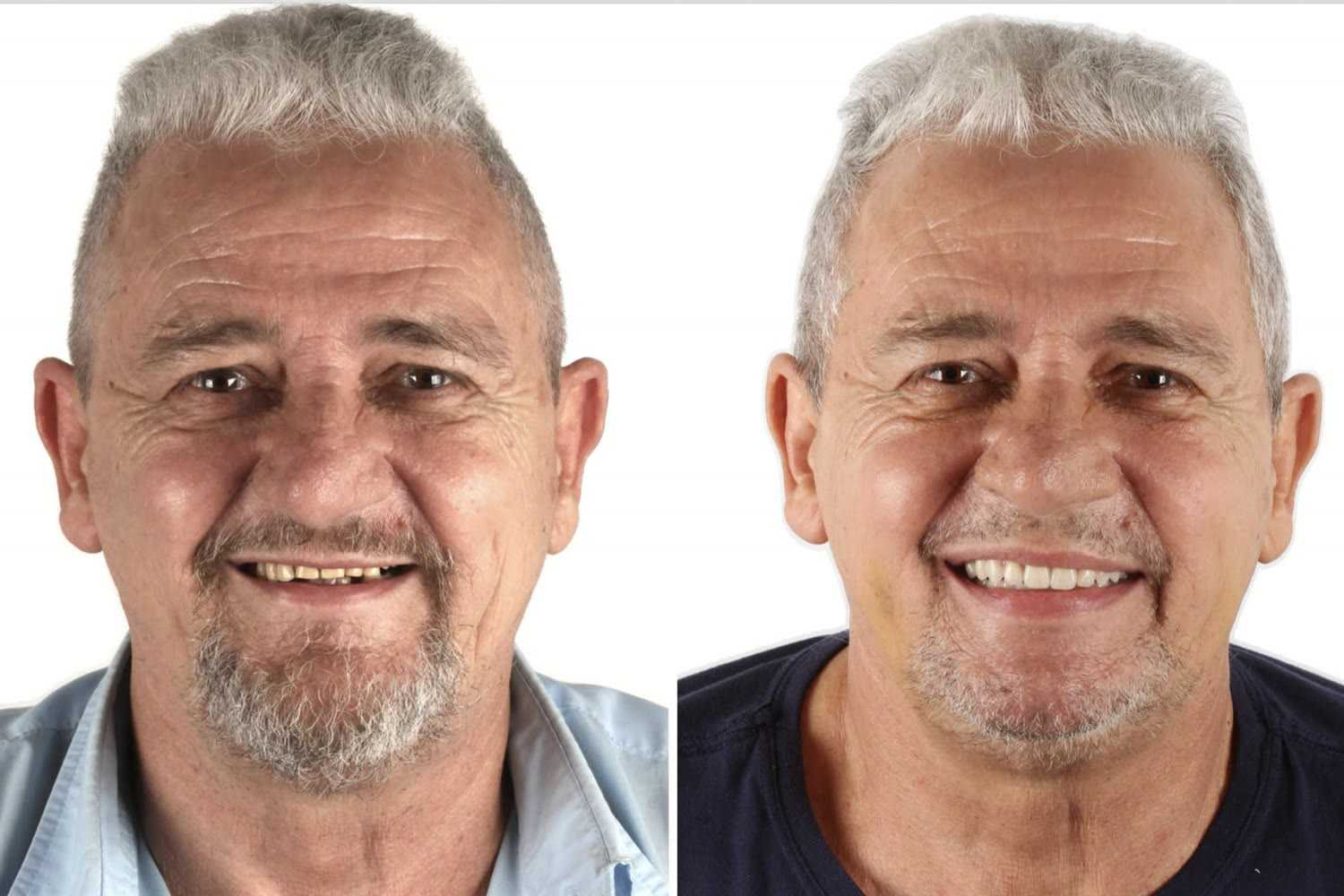 Before and after: patient rehabilitated with zygomatic implants and the FaceFirst approach at Clinica Dr. Fernando Giovanella, Blumenau, Brazil