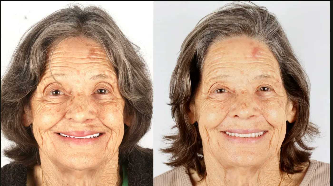 Before and after: patient rehabilitated with the FaceFirst approach and zygomatic implants, with her smile and facial support restored