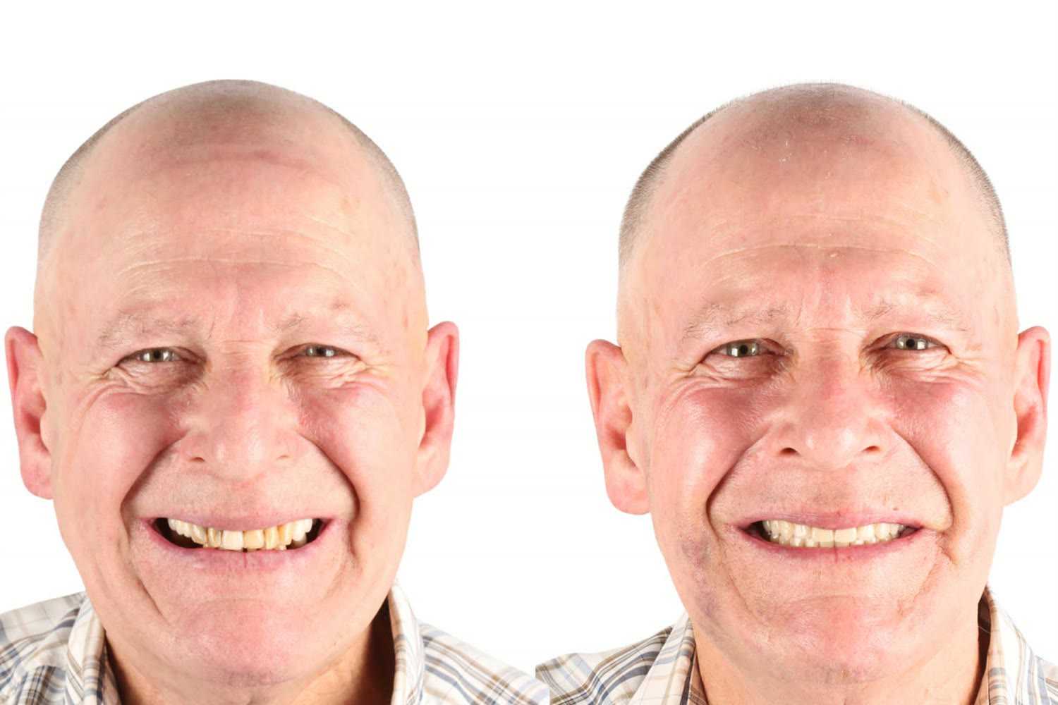 Before and after: patient who came from Canada to Blumenau, Brazil