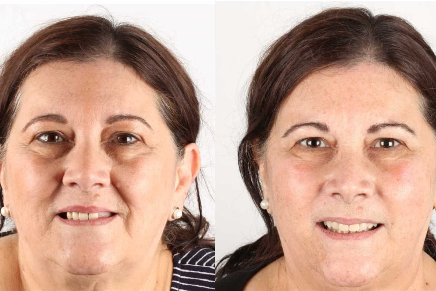 Before and after: patient who came from the United States to Blumenau, Brazil