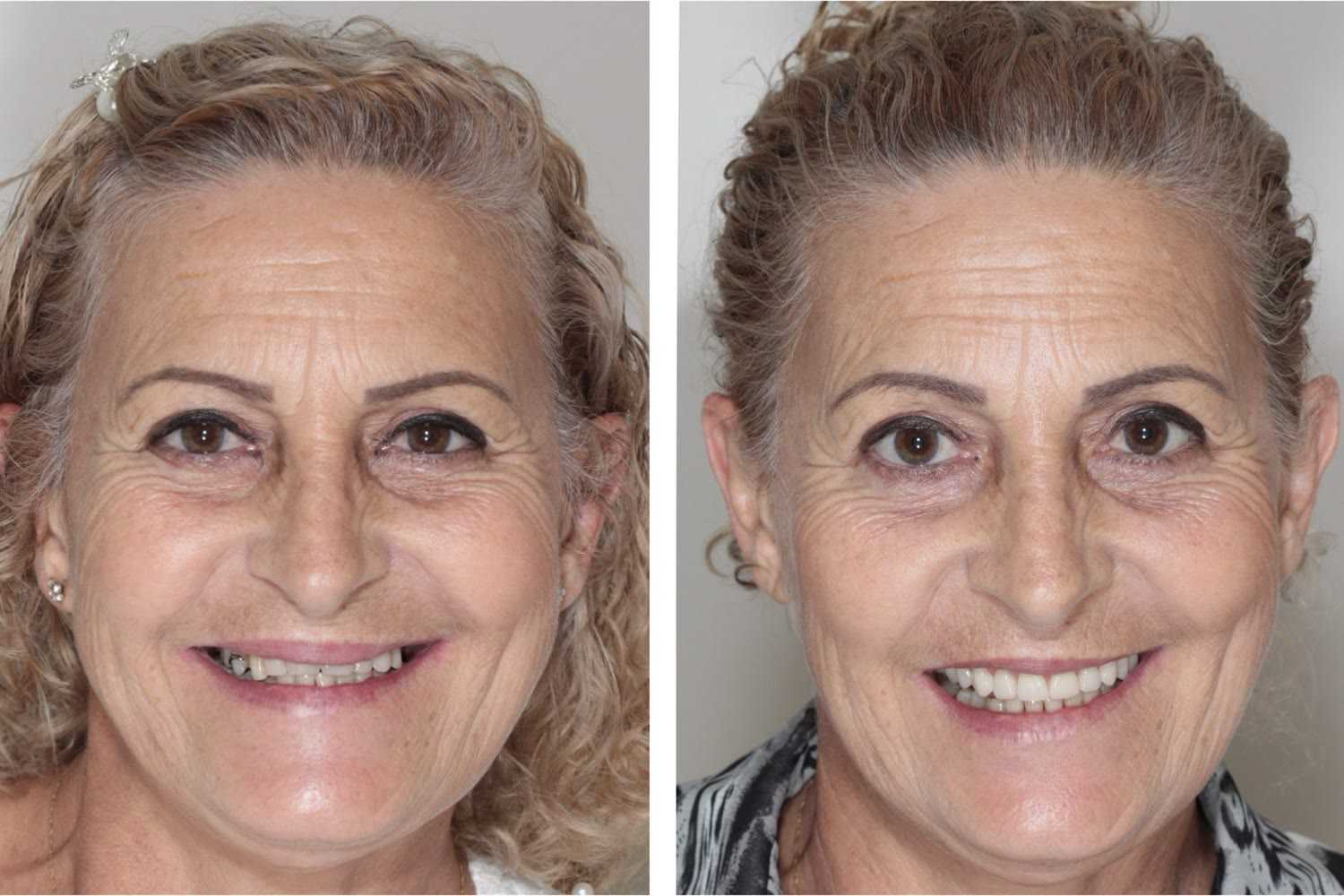 Before and after: full rehabilitation with fixed teeth
