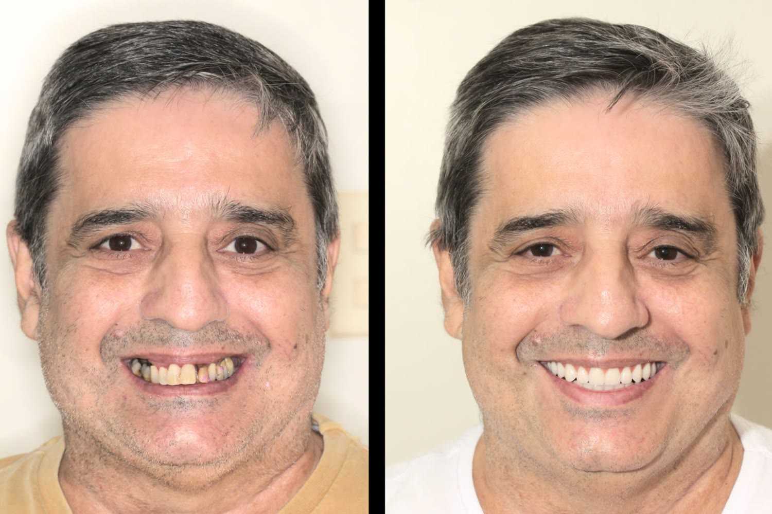 Before and after: rehabilitation with fixed teeth on implants