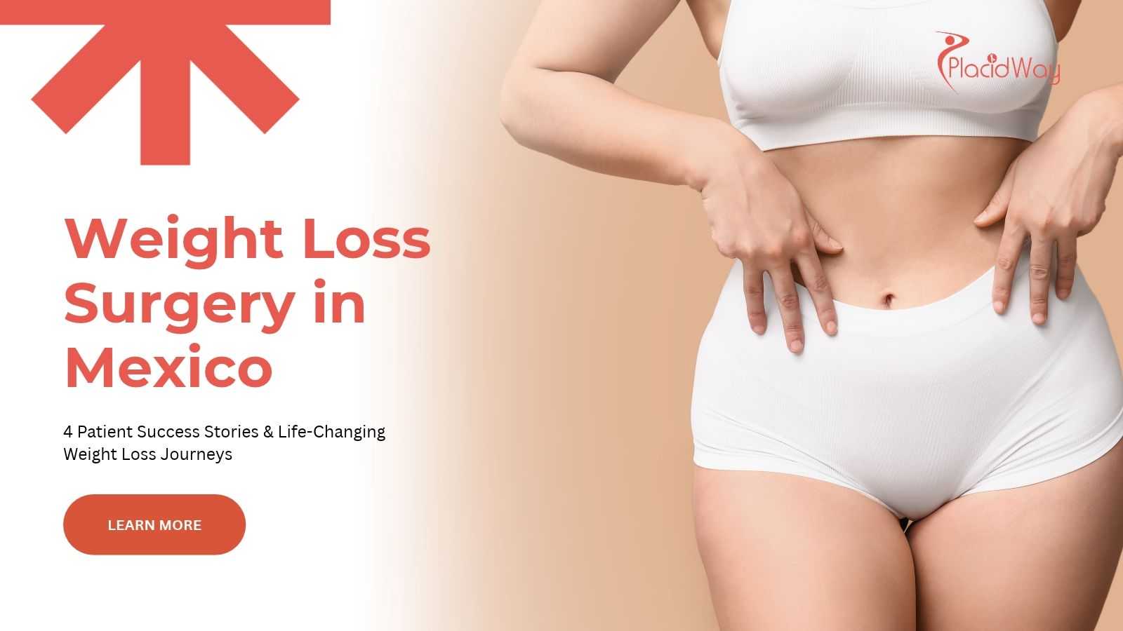 Weight loss surgery success stories in Mexico