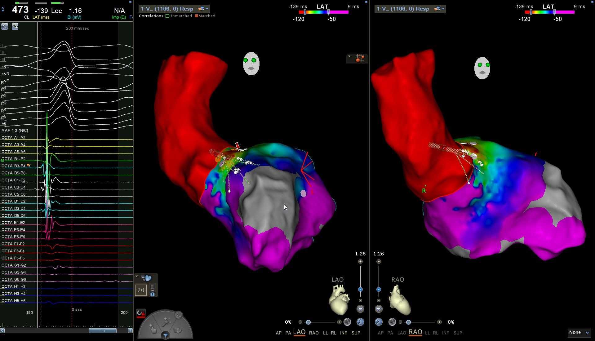 Cardiac Mapping for Atrial Flutter Ablation in Murcia, Spain by Dr. Gil's Arrhythmia Care