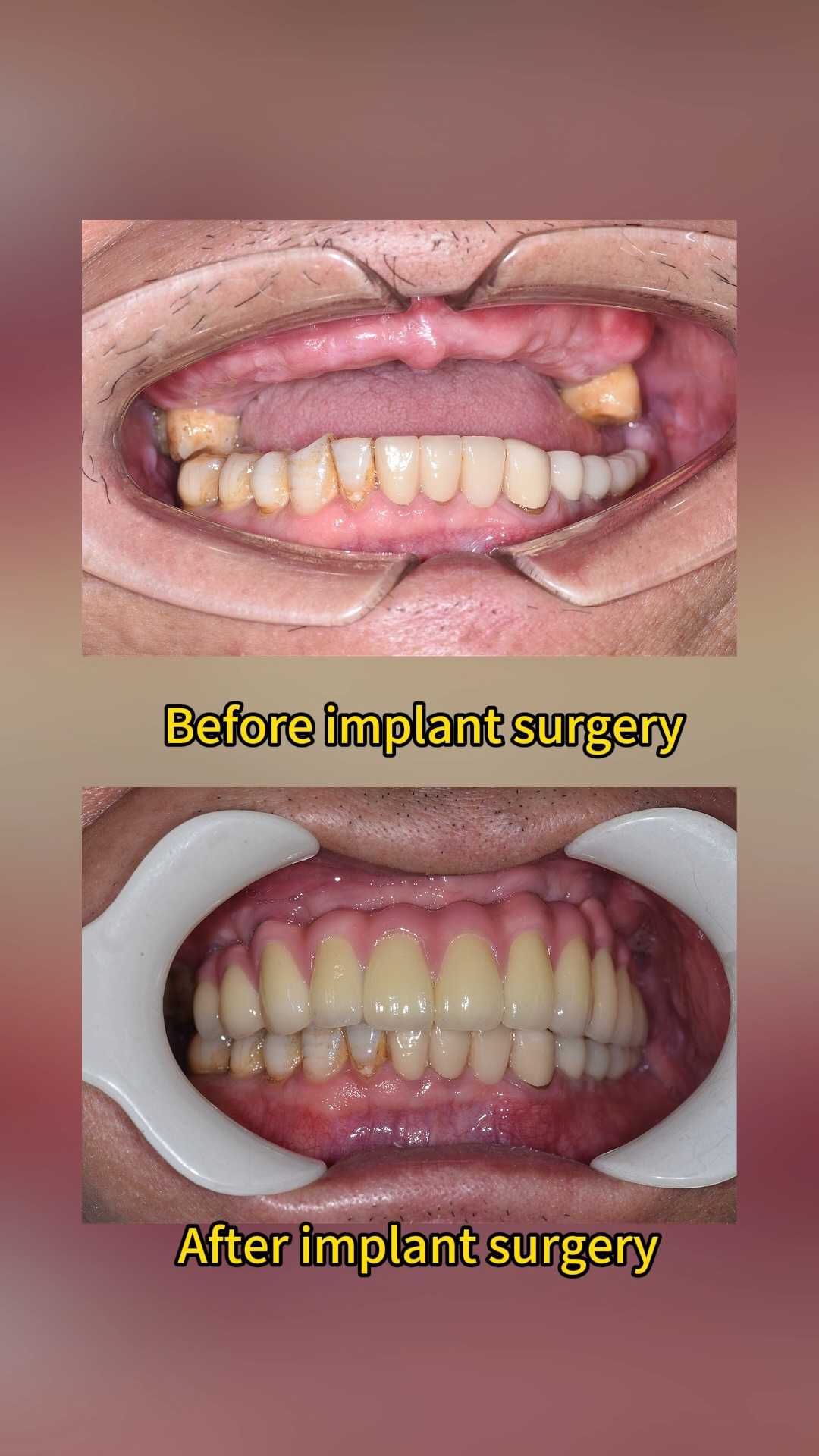 Before and after full-arch dental implant restoration at Qinghua Sunshine Dentistry in Wuhan, China