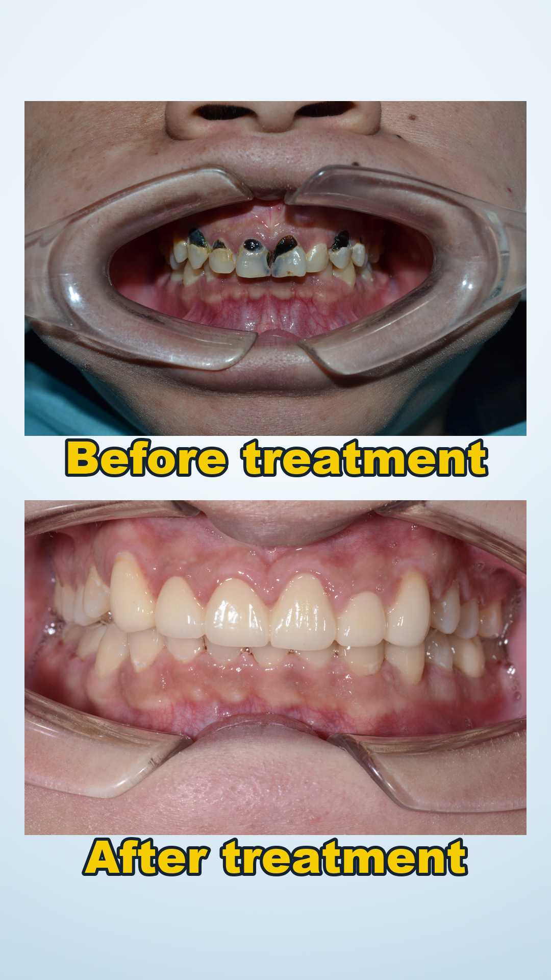 Before and after root canal treatment and all-ceramic crowns at Qinghua Sunshine Dentistry