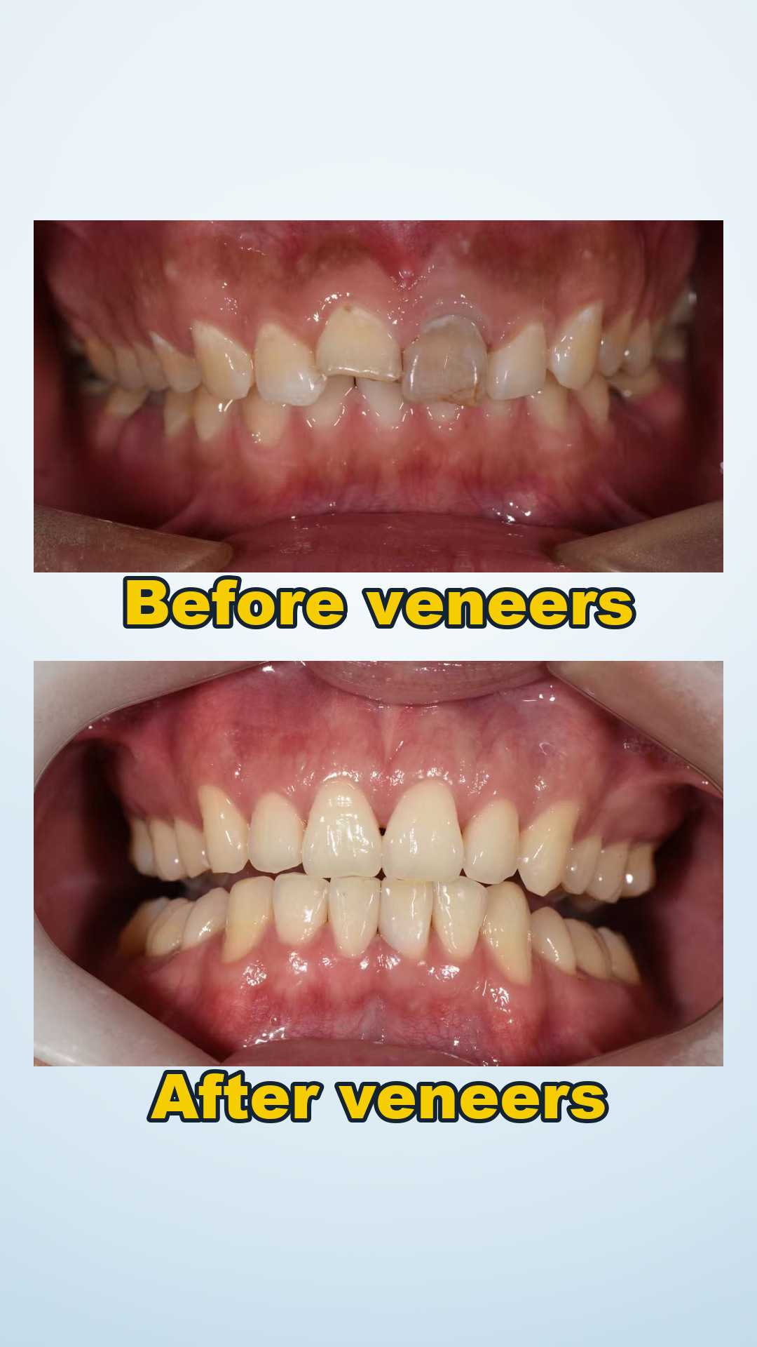 Before and after porcelain veneer smile makeover at Qinghua Sunshine Dentistry in China
