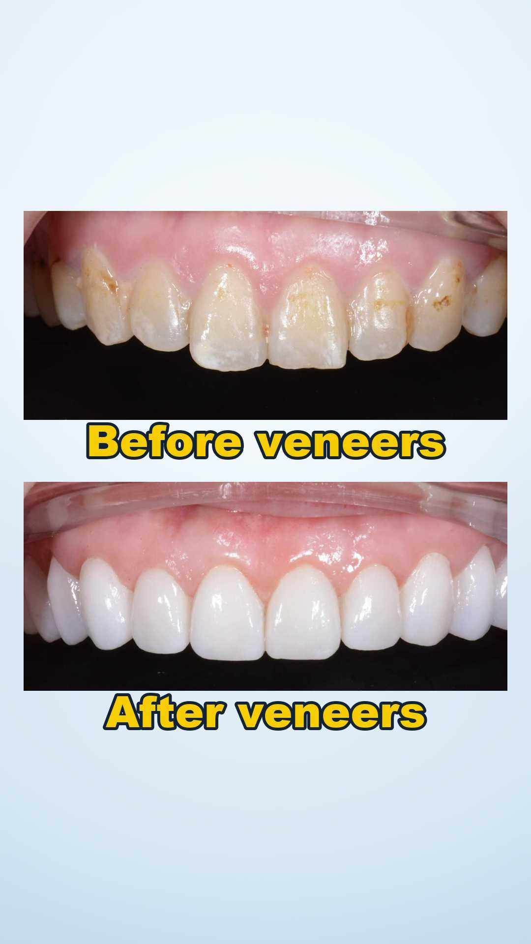 Before and after ceramic veneers for upper anterior teeth at Qinghua Sunshine Dentistry