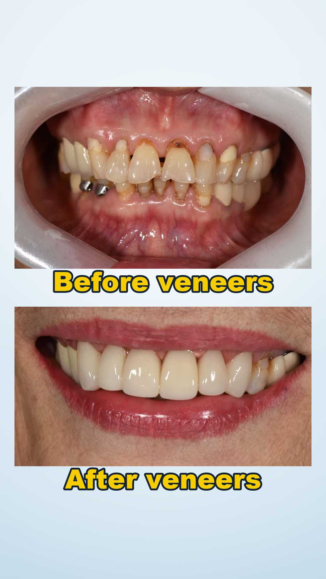 Before and after eight-unit E-max porcelain veneers at Qinghua Sunshine Dentistry