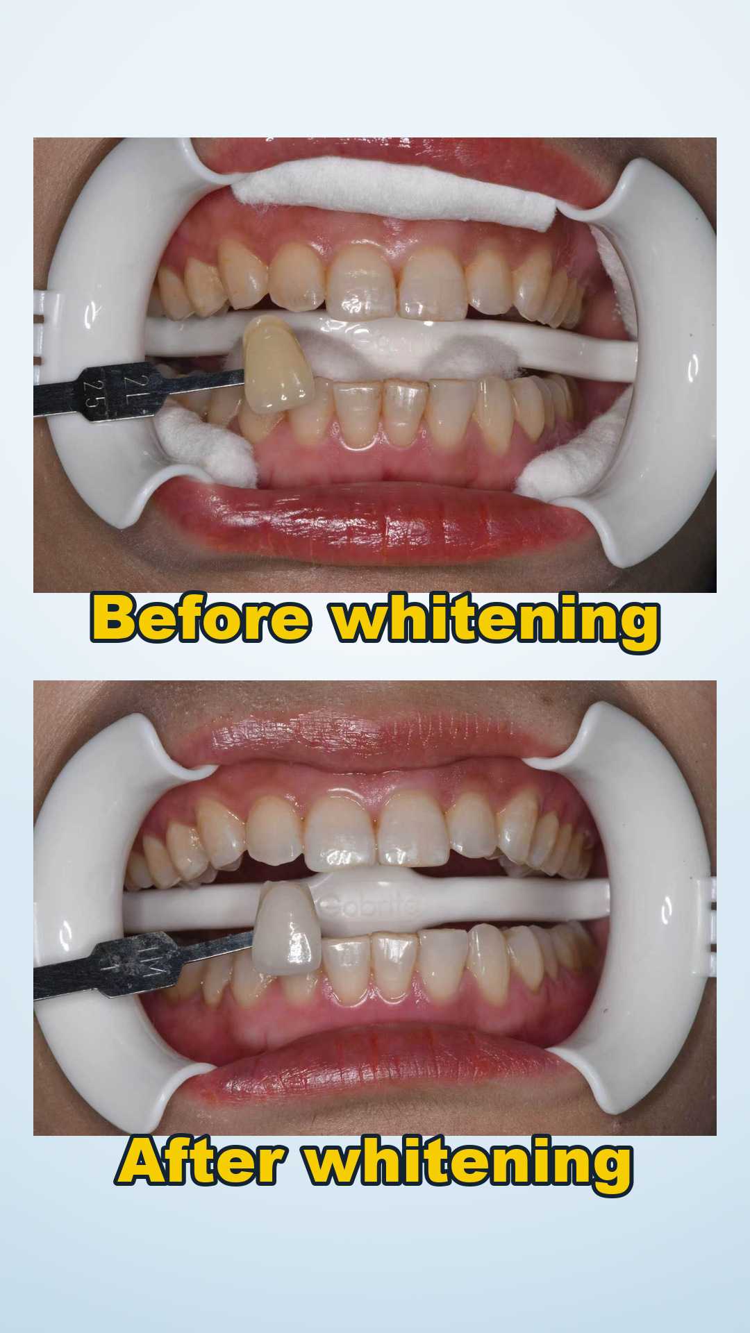 Before and after in-office teeth whitening at Qinghua Sunshine Dentistry in Wuhan