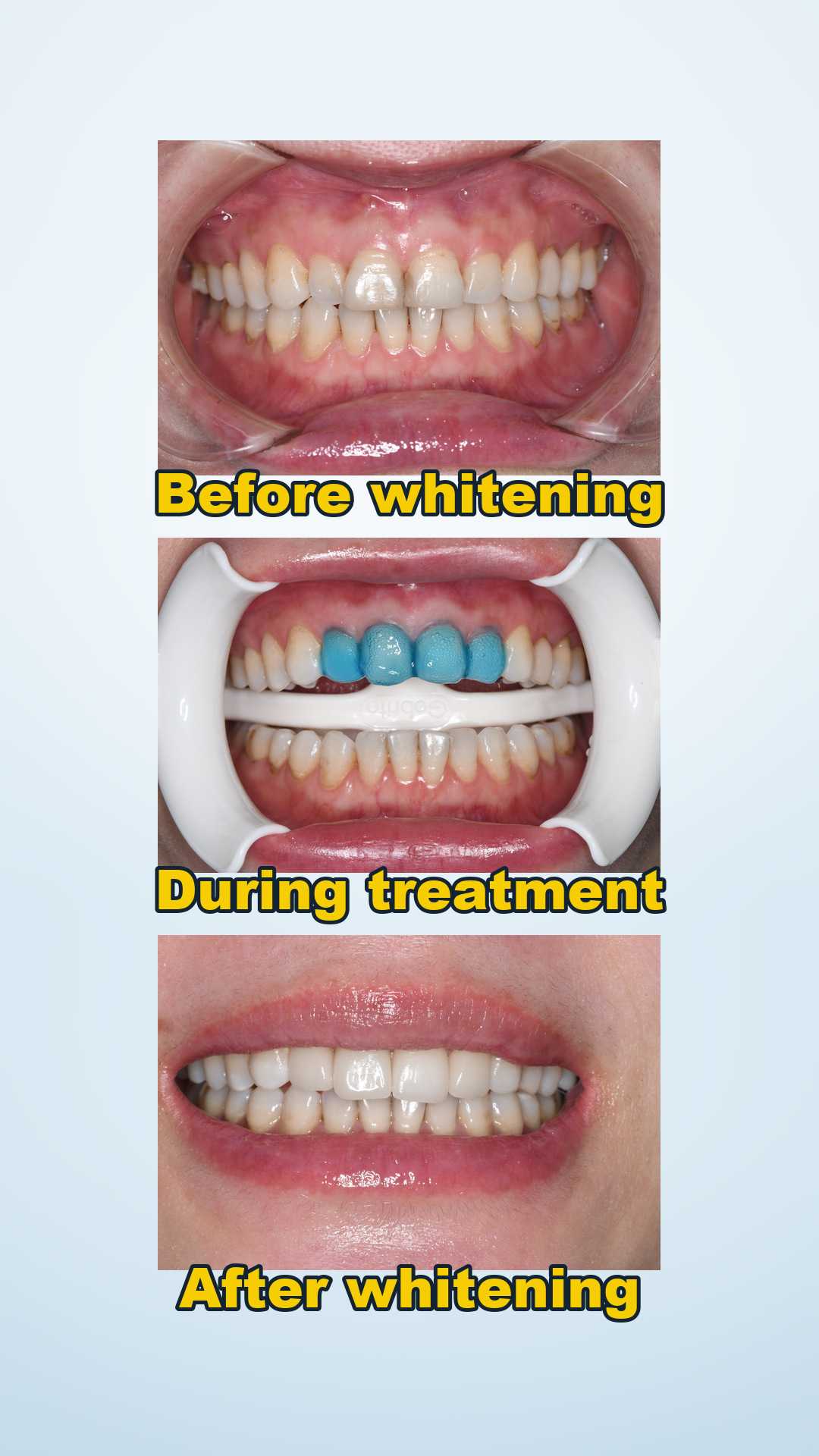 Before and after professional teeth whitening with shade comparison at Qinghua Sunshine Dentistry