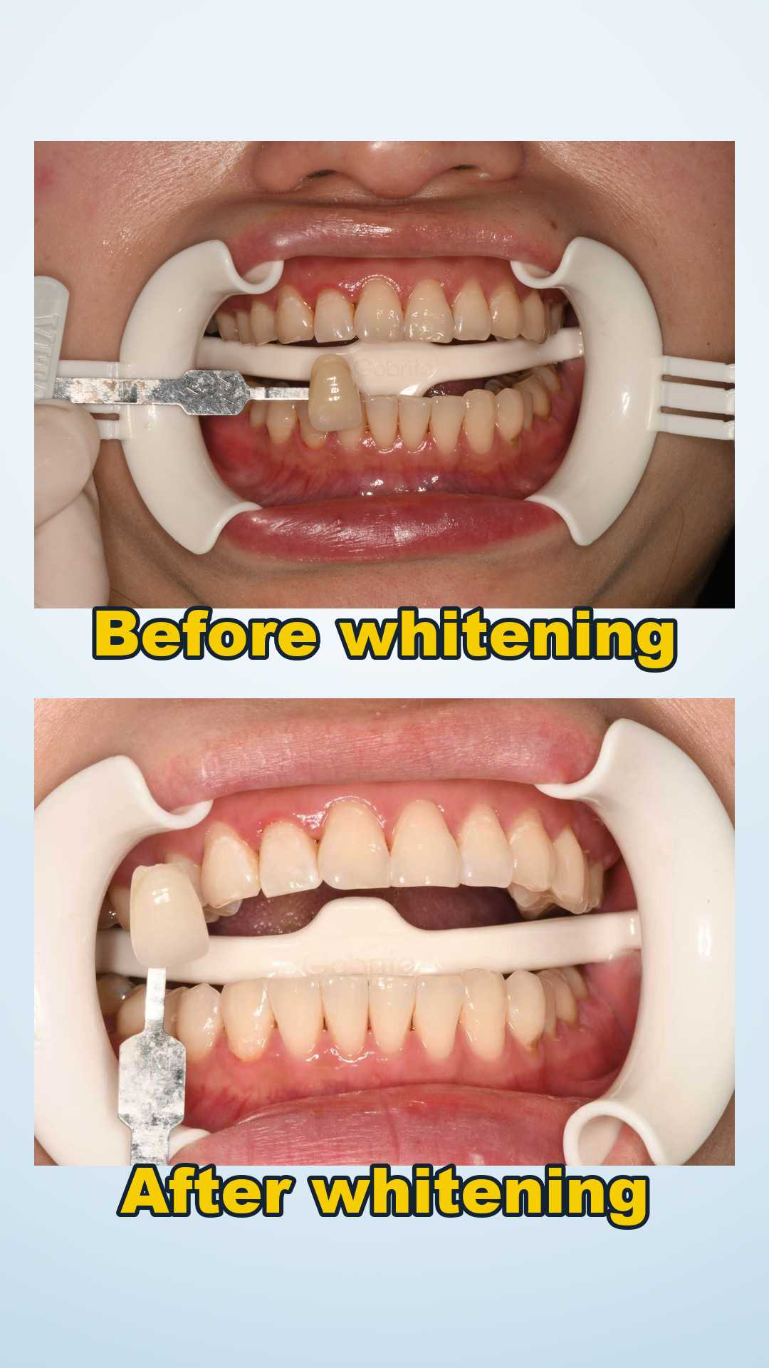 Before and after professional teeth whitening with scaling and polishing at Qinghua Sunshine Dentistry