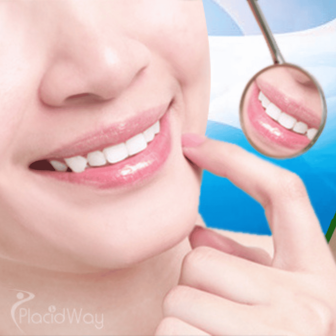 Dentadura Fija Sobre 4 Implantes Precio México