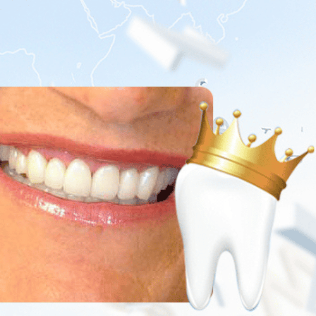 El tratamiento más solicitado de coronas dentales en Cali, Colombia