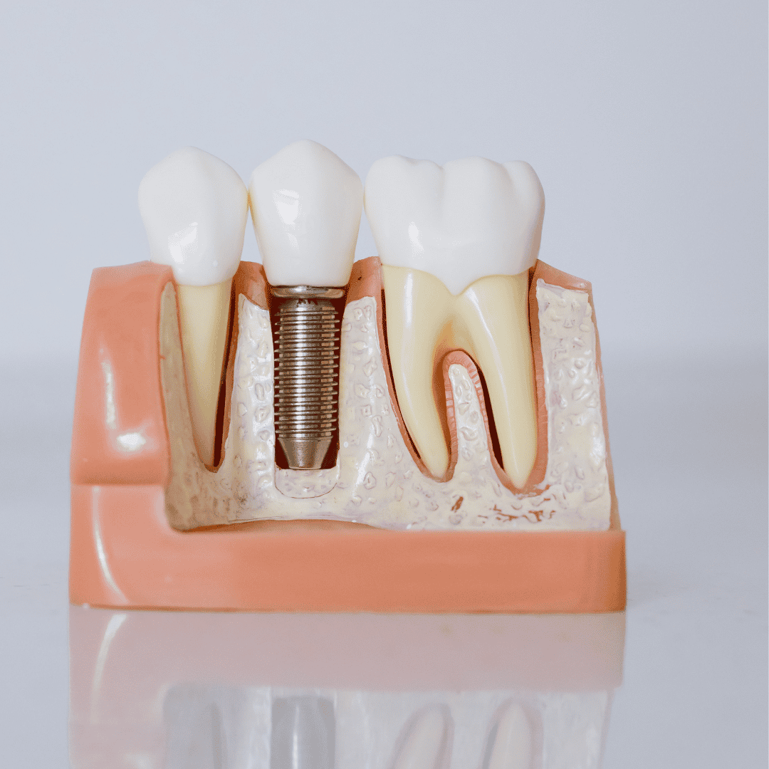 What to Expect From Dental Implants in Los Algodones, Mexico