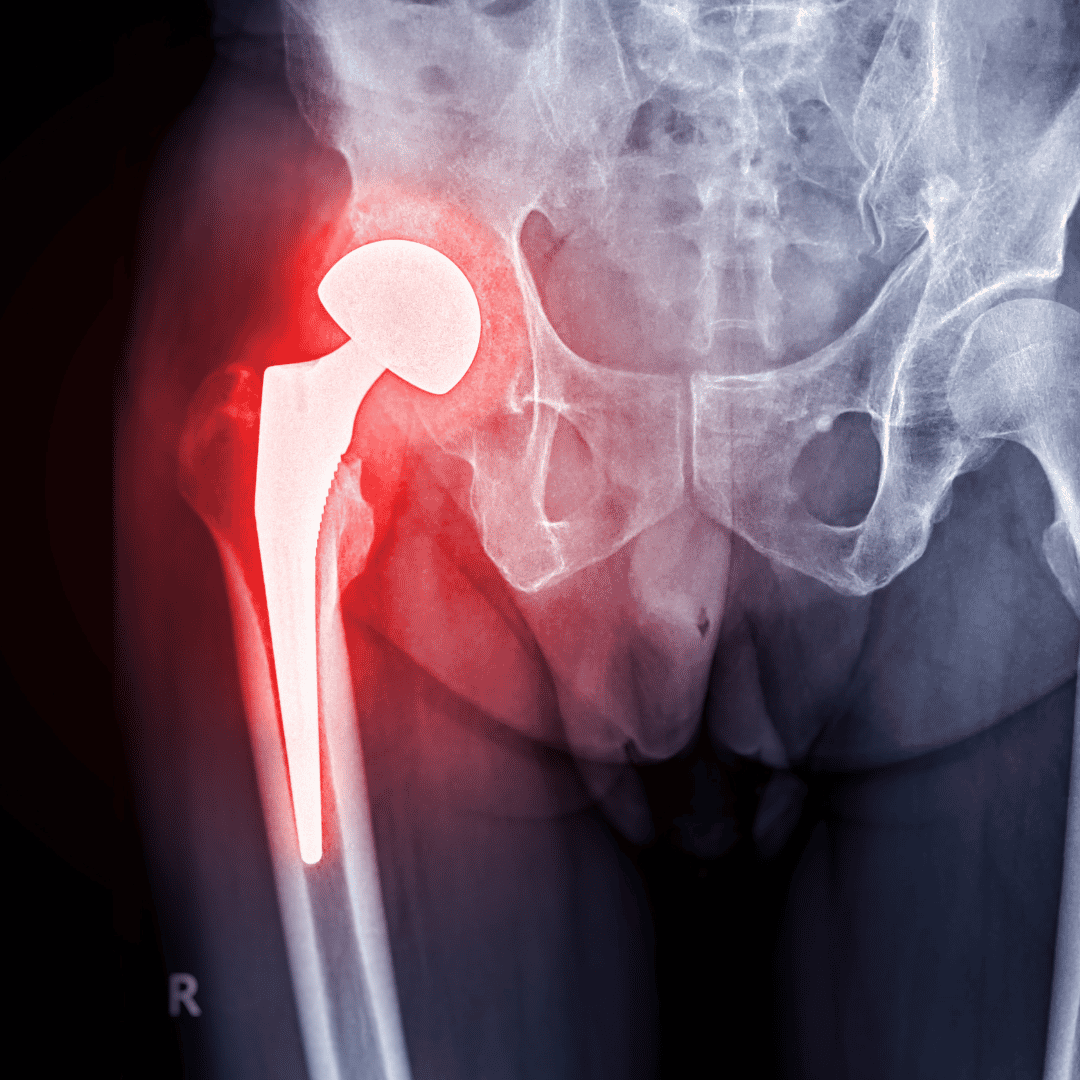 Hip Resurfacing in Istanbul: Cutting-Edge 2026 Techniques