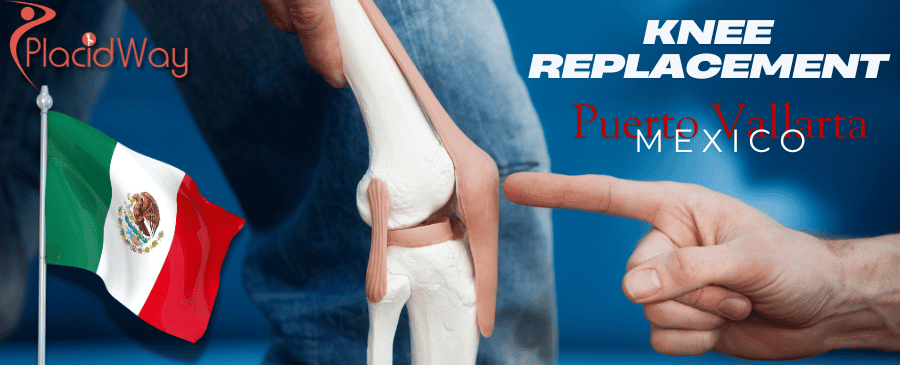 Knee Replacement in Puerto Vallarta, Mexico 2026