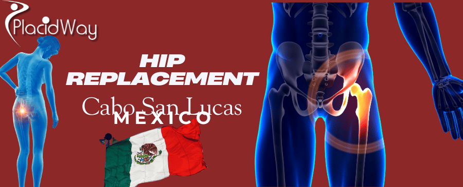 Hip Replacement in Cabo San Lucas, Mexico
