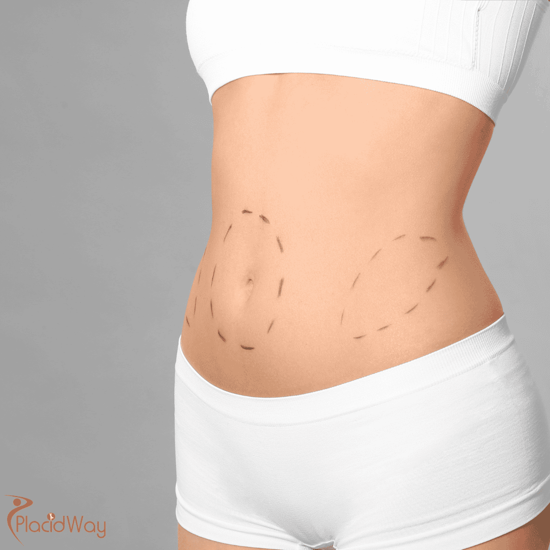 Choosing Liposuction in Colombia: What to Evaluate Before Treatment
