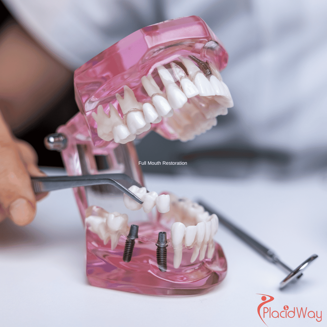 Full Mouth Restoration in Costa Rica: Affordable Solutions for a Perfect Smile