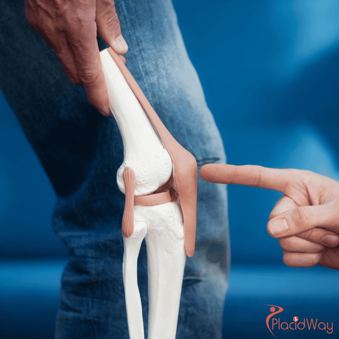 Best Place To Get a Knee Replacement in The World