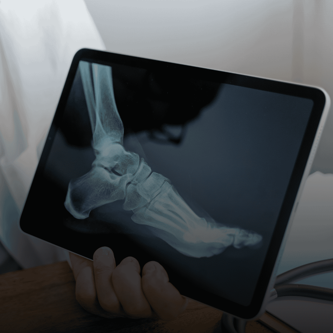 Orthopedic Surgery: Why Choose Cancun and Puerto Vallarta