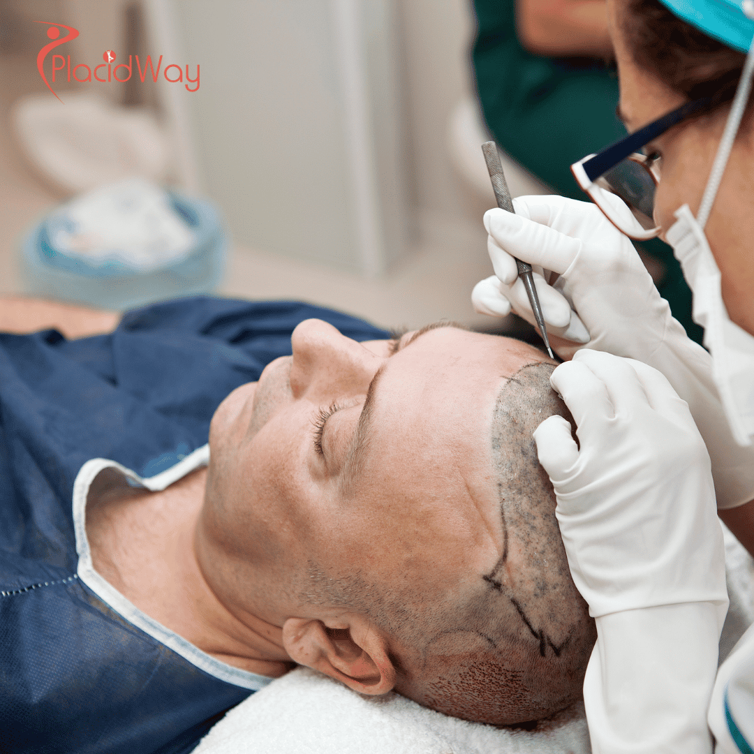 Hair Transplants in Turkey: Affordable Solutions for Canadians Seeking Hair Restoration