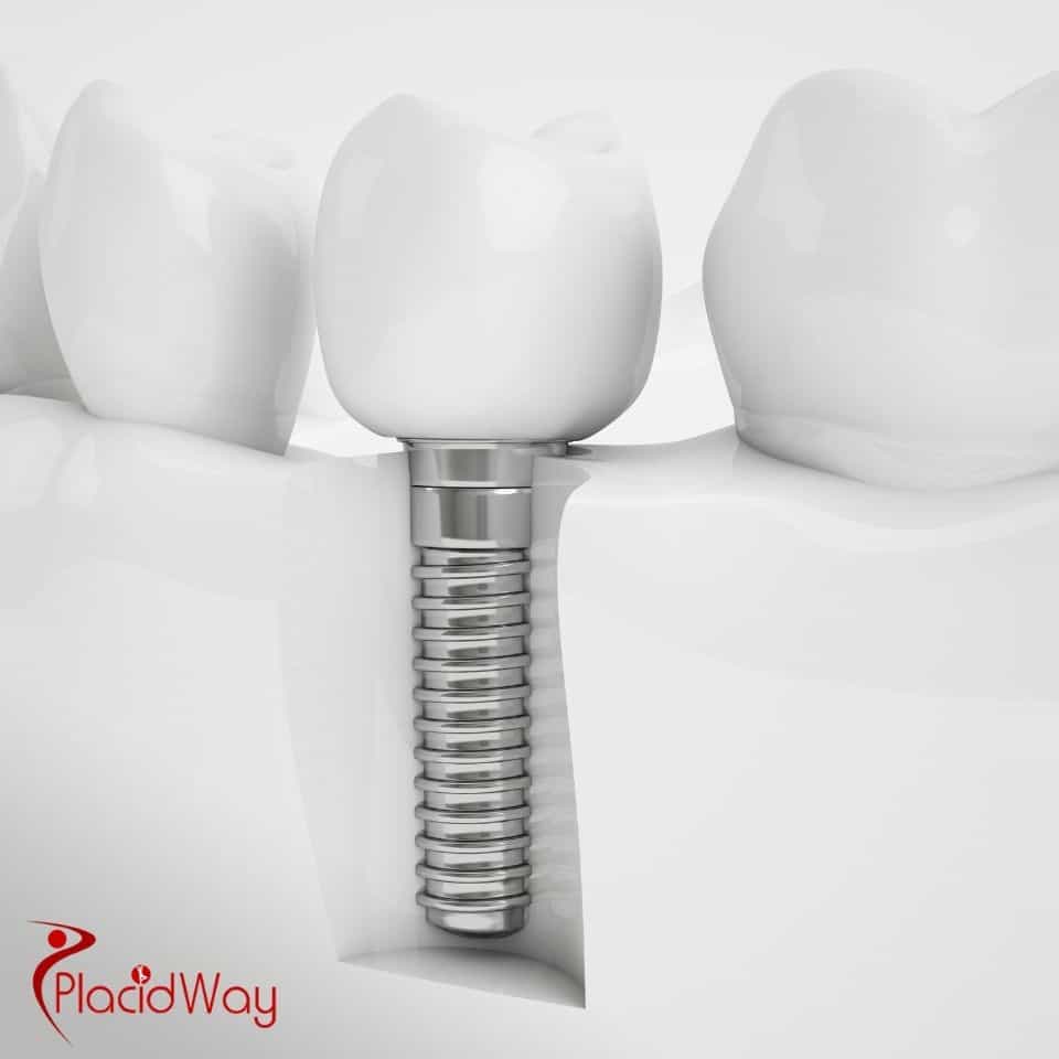 Zahnimplantate in der Türkei: Warum deutsche Patienten sich für All-on-4-Implantate für eine vollständige Lächelnwiederherstellung entscheiden