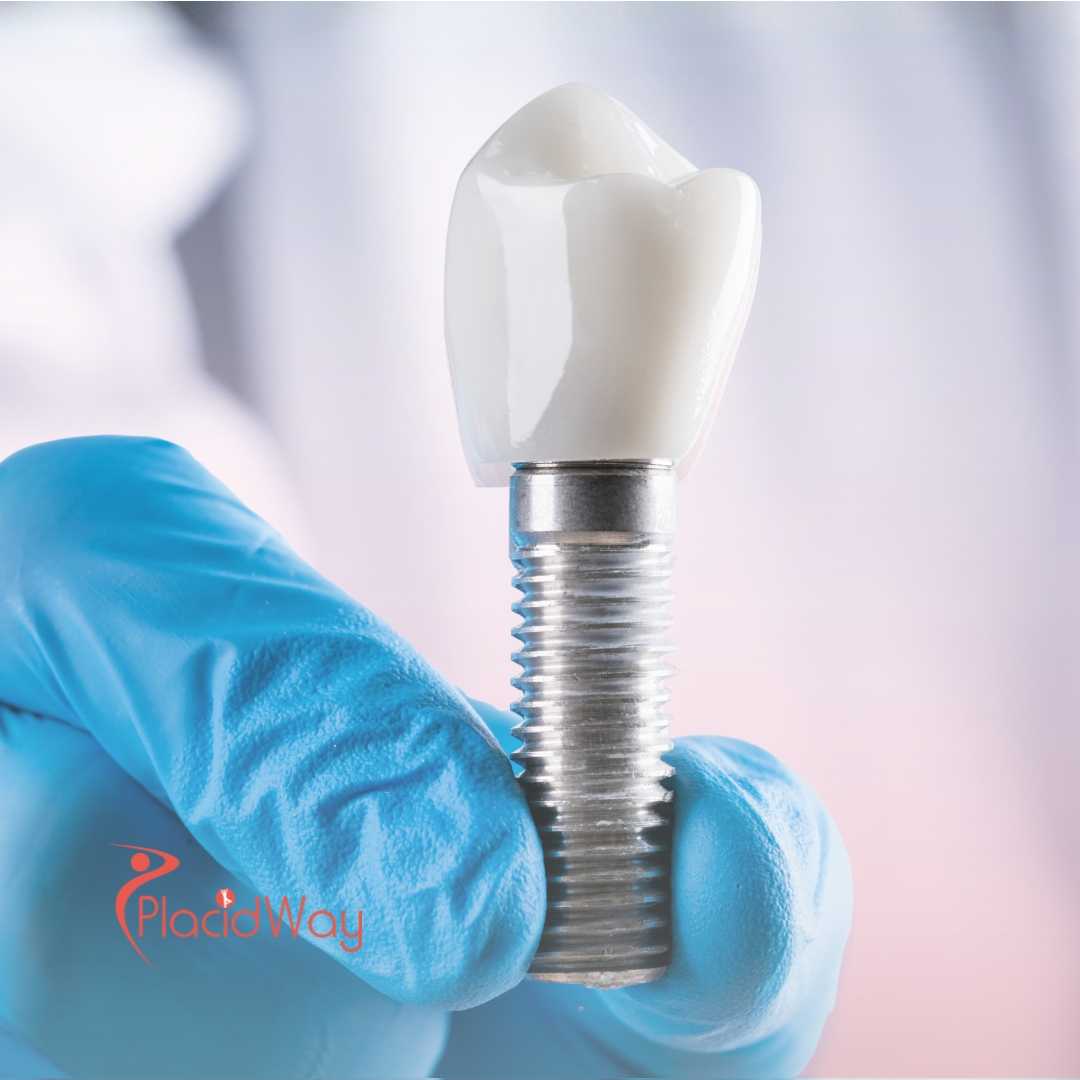 Get the Best Dental Implants in Los Algodones, Mexico: A Complete Guide for Californians